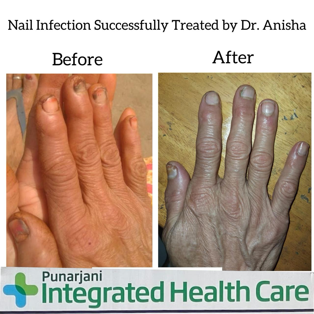 Nail infection Successfully Treated by Dr. Anisha